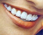 Aparelho dentrio esttico (brackets e fio transparentes)
